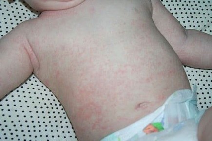 Кожная сыпь у детей: когда стоит беспокоиться