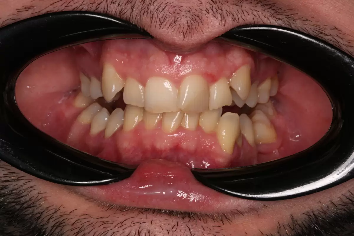 Скученность зубов: почему стандартная чистка неэффективна и как ее улучшить